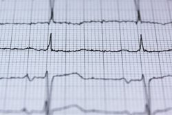 ECG Report For Detecting Heart Issues ECG Report For Detecting Heart Issues