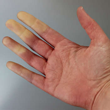 Raynauds Raynauds