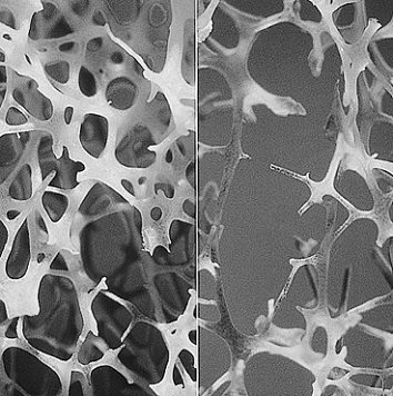 bone comparison osteoporosis bone comparison osteoporosis