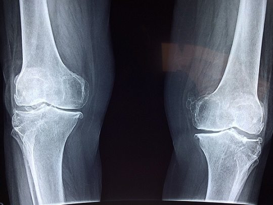 Knee Bone XRay Knee Bone XRay